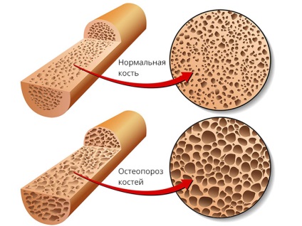 Osteoporoza și simptomele și tratamentul la adulți și copii