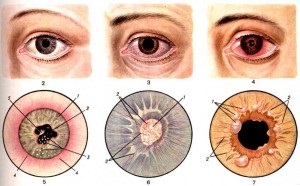 Caracteristici serioase de iridocilită serică și tratament