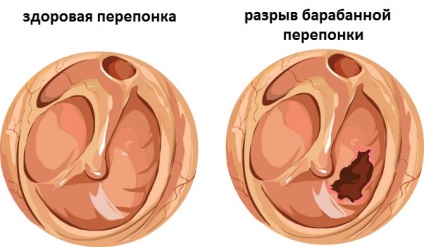 Otita la copii, simptome și tratament, prevenire