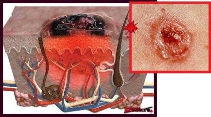 Papilloma sângerează ce trebuie să facă