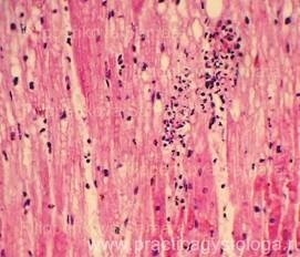 Dystrofii parenchimatoase - practica histologului - informații despre sănătate