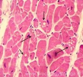 Dystrofii parenchimatoase - practica histologului - informații despre sănătate