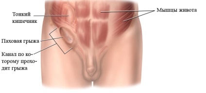 Inghinală simptomele herniei oblice, semne, diagnostic și tratament