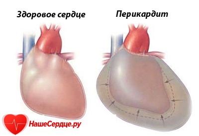 Перикардит симптоми, лечение и видове