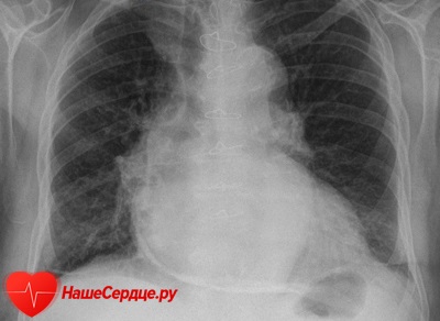 Pericarditis tünetek, kezelés és típusok