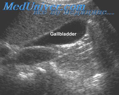 Pericholecystitis și vezicii biliare contractate