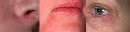 Dermatita orala - ce boala si cum sa o luptati