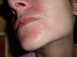 Orális dermatitis a betegség arckezelésében