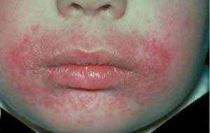 Dermatită orală pe tratamentul feței bolii