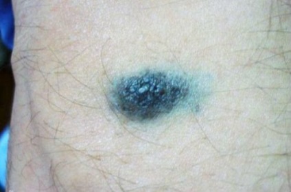 Negru pigmentar intradermic, displazic, limită