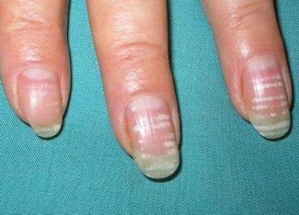 De ce pe unghiile apar materiale de pete albe pentru extensiile unghiilor