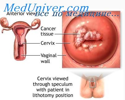 Modificări precanceroase în colul uterin