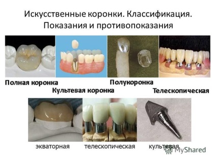 Prezentarea principiilor tratamentului ortopedic al țesuturilor dentare cu coroane metalice