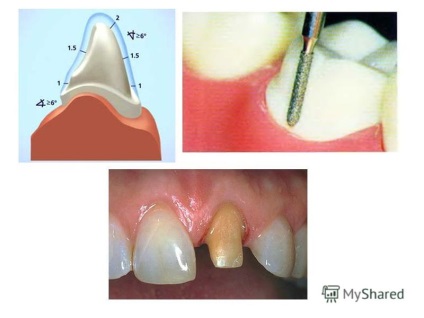 Bemutatás a fogak kemény szövetének ortopédiai kezelésével fém koronákkal