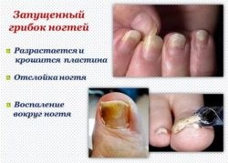 Ciuperca unghiilor de la degetul mare: tratament, la domiciliu
