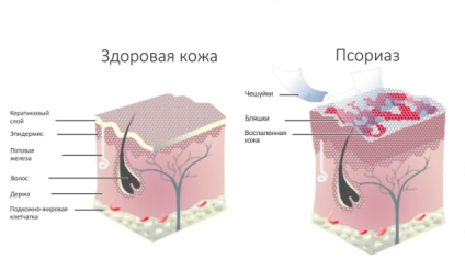 Fotografiile psoriazisului, simptomele, cauzele și tratamentul bolii