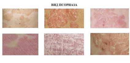 Fotografiile psoriazisului, simptomele, cauzele și tratamentul bolii