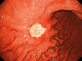 Cancer al simptomelor stomacului, cauze, tratament în clinica mgu numele de Lomonosov