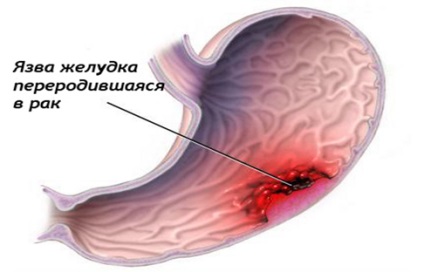 Cancer al simptomelor stomacului, cauze, tratament în clinica mgu numele de Lomonosov