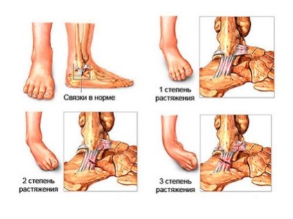 Stretching al simptomelor articulației gleznei și tratament