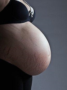 Măsurile de întindere după naștere, cum să curăță, să scape vergeturile de pe abdomen, piept după naștere, populare