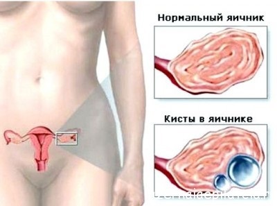 Ruptura chistului ovarian - simptome, tratament, prevenire