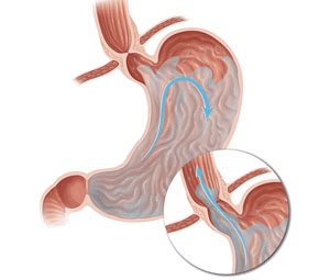 Reflux-eesophagitis tünetei és kezelése