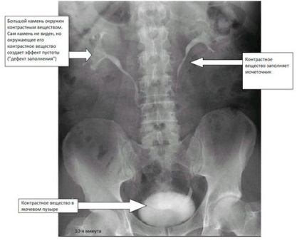 X-ray a rinichilor cu substanță de preparat pentru contrast și cum se face