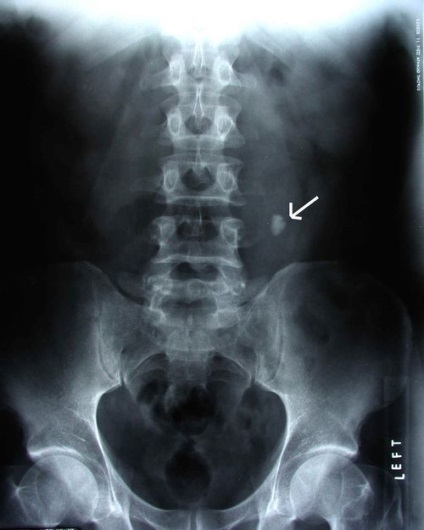 X-ray a rinichilor cu substanță de preparat pentru contrast și cum se face