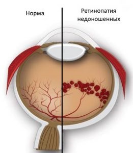 Az idő előtti retinopathia, jelek, okok