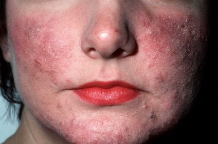 Rosacea de îngrijire a pielii - cum să vă ajutați cu rozacee