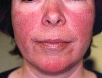 Rosacea - îngrijirea pielii facială - biblioteca medicală