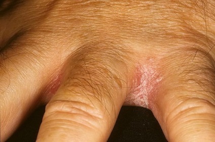 Factori serioși și inofensivi ai apariției de pete pe picioare și între degete, sunt un favorit