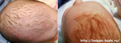 Îndepărtarea pielii de la nou-născut - ce trebuie să faceți