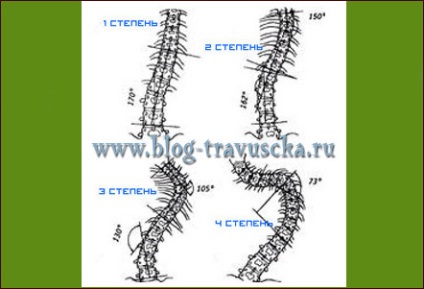 Scolioza simptomelor coloanei vertebrale și tratamentul gimnasticii