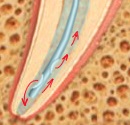 Fogászati ​​tűk a gyökérdugók tűinek öntözéséhez endodontikus orvosi lomza bogmark