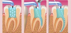Ace dentare pentru irigarea canalelor radiculare endodontice medicale lomza bogmark