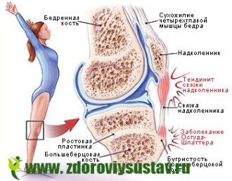 Tendinita genunchiului provoacă simptome, moduri de tratament