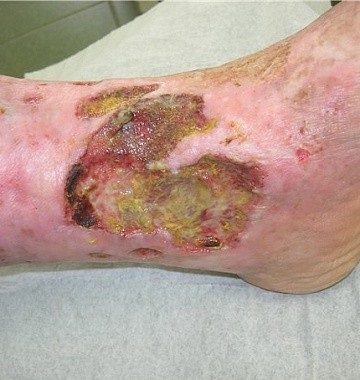Ulcerul trofic pe picior cu medicamente