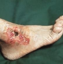 Ulcerul trofic pe picior cu medicamente