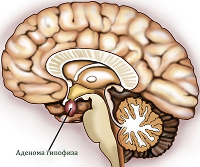 TURP – rezectia endoscopica a prostatei