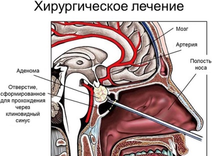 Eliminarea metodelor de tratare și reabilitare a adenomului hipofiza după intervenție chirurgicală