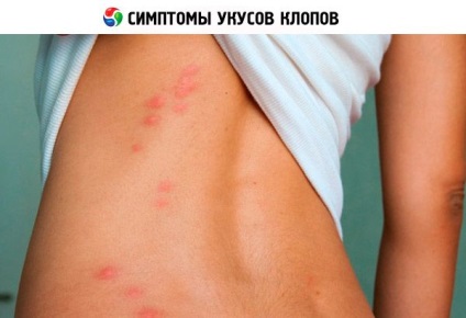 Bite bug-uri pe corpul uman în timp ce arata, tratament, competent despre sănătate pe ilive