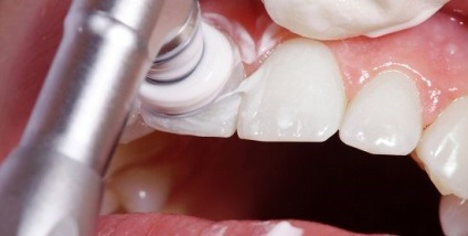 Curățarea cu ultrasunete a dinților este bună, rău, video