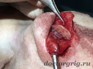 Extracție nazală cu chirurgie, fotografie