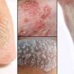 Îngrijirea pielii cu rosacee și tratament eficient