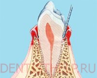 Tipuri de parodontita, fotografie; forme de parodontită acută și cronică, tratament