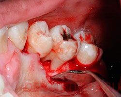 Periodontitis, fotó; az akut és krónikus periodontitis formái, kezelés