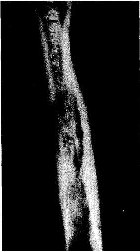 Intraosseous chondroma - patologie osoasă, displazie și tumori osoase - chirurgie