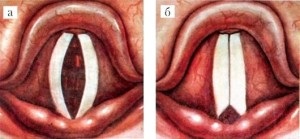 Chondroperichondrita laringelui, ca cauză a durerii în gât